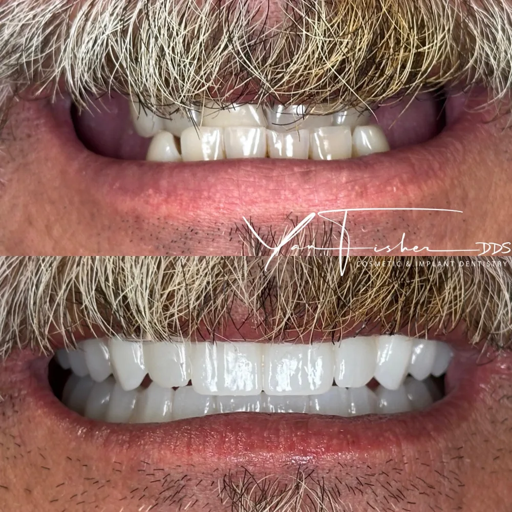 Before and after smile transformation