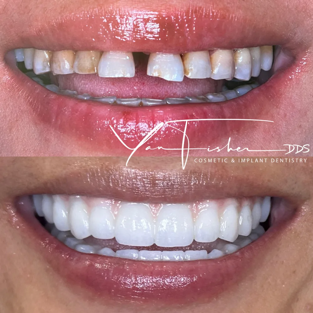 Before and after smile transformation