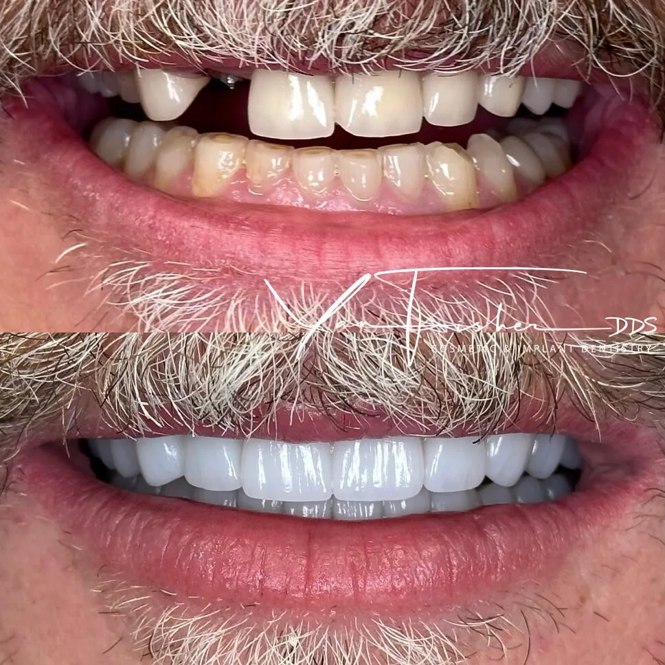 Before and after smile transformation