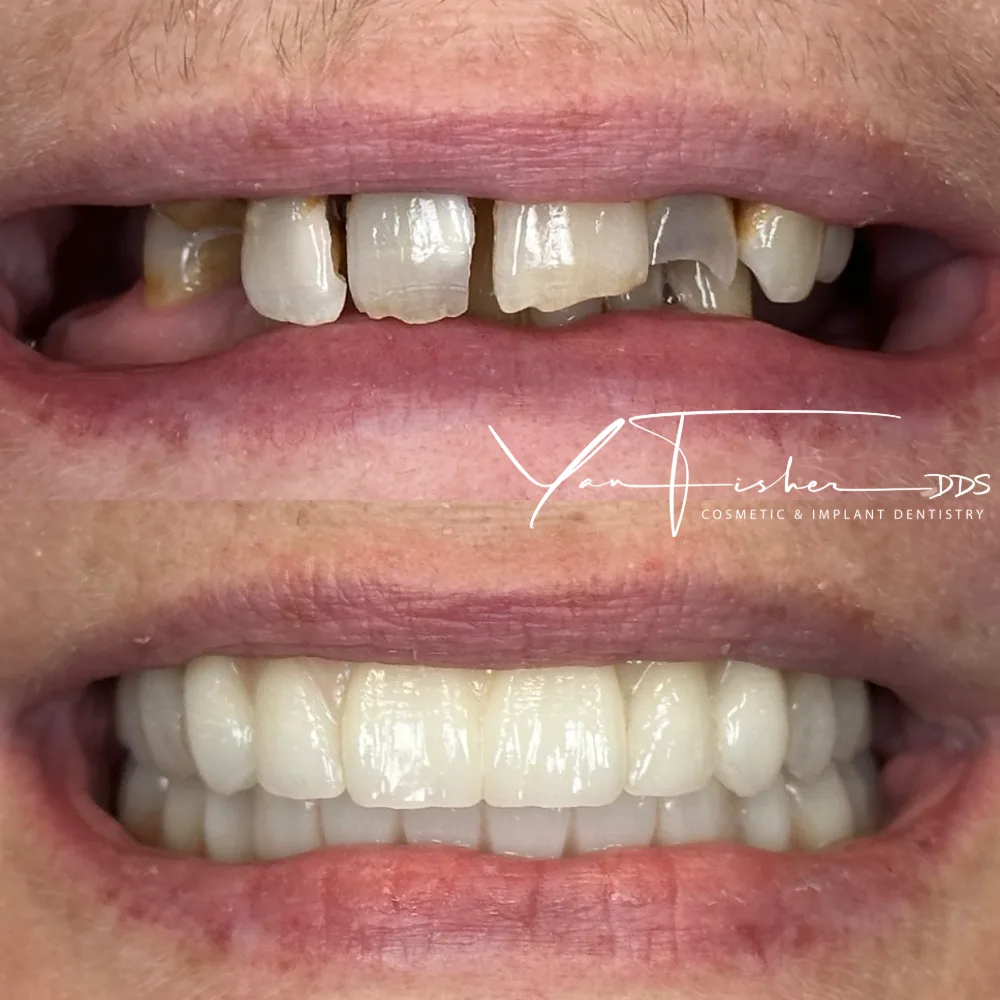 Before and after smile transformation