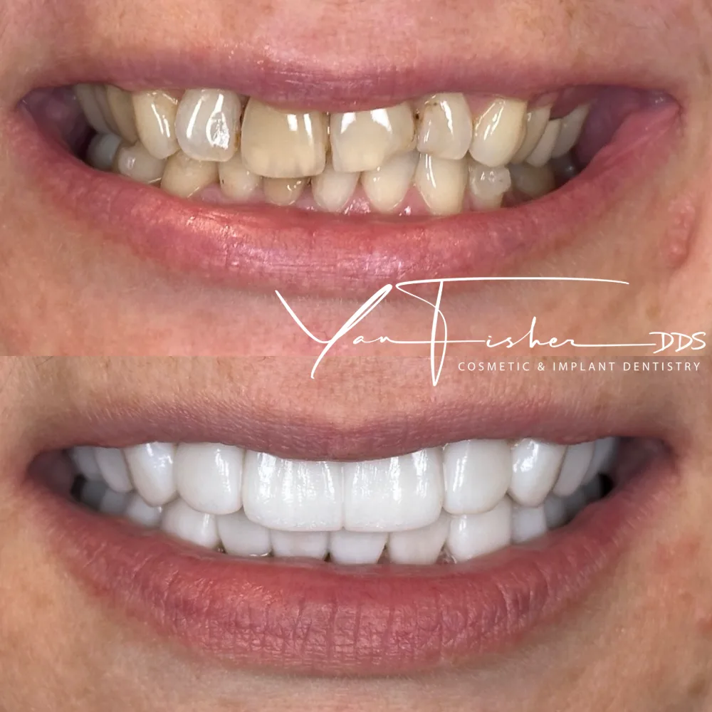 Before and after smile transformation