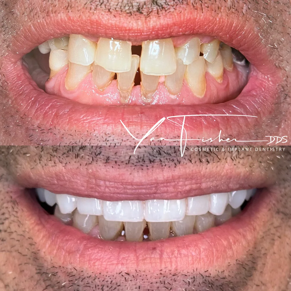 Before and after smile transformation