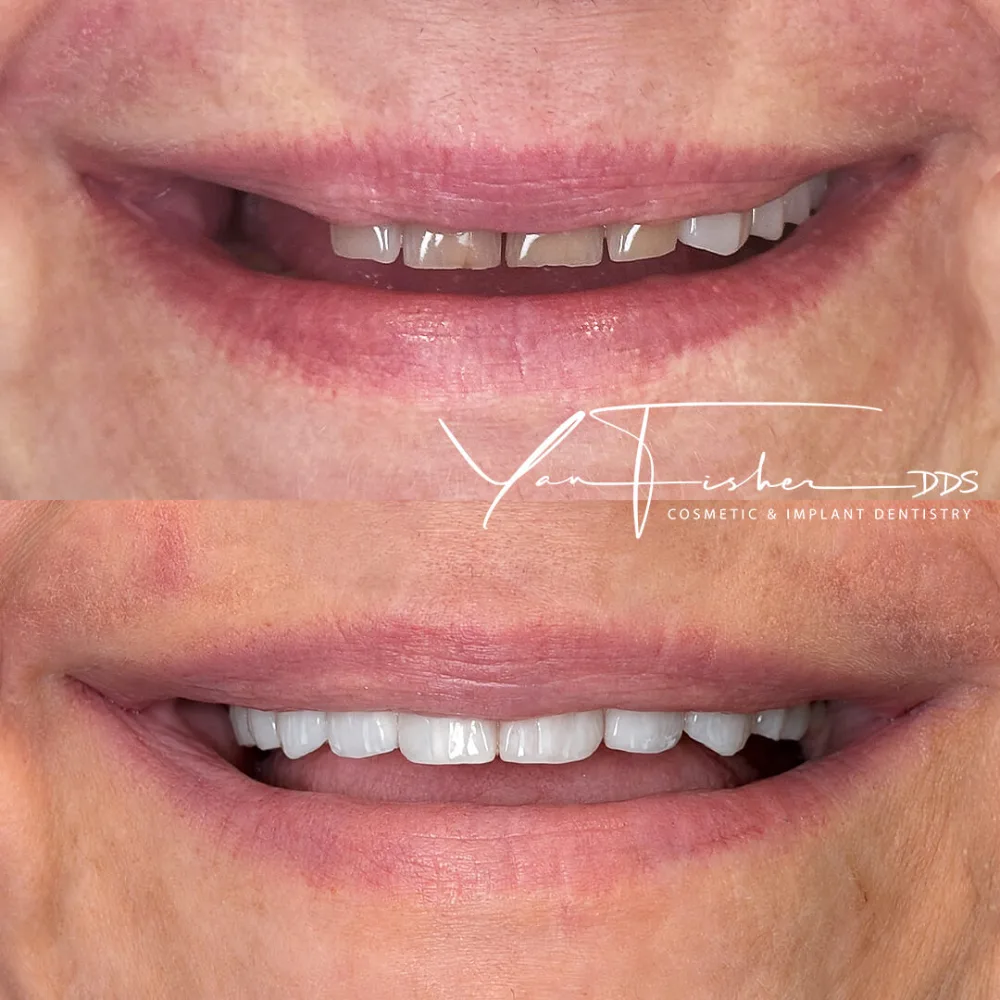 Mila Before and After Smile