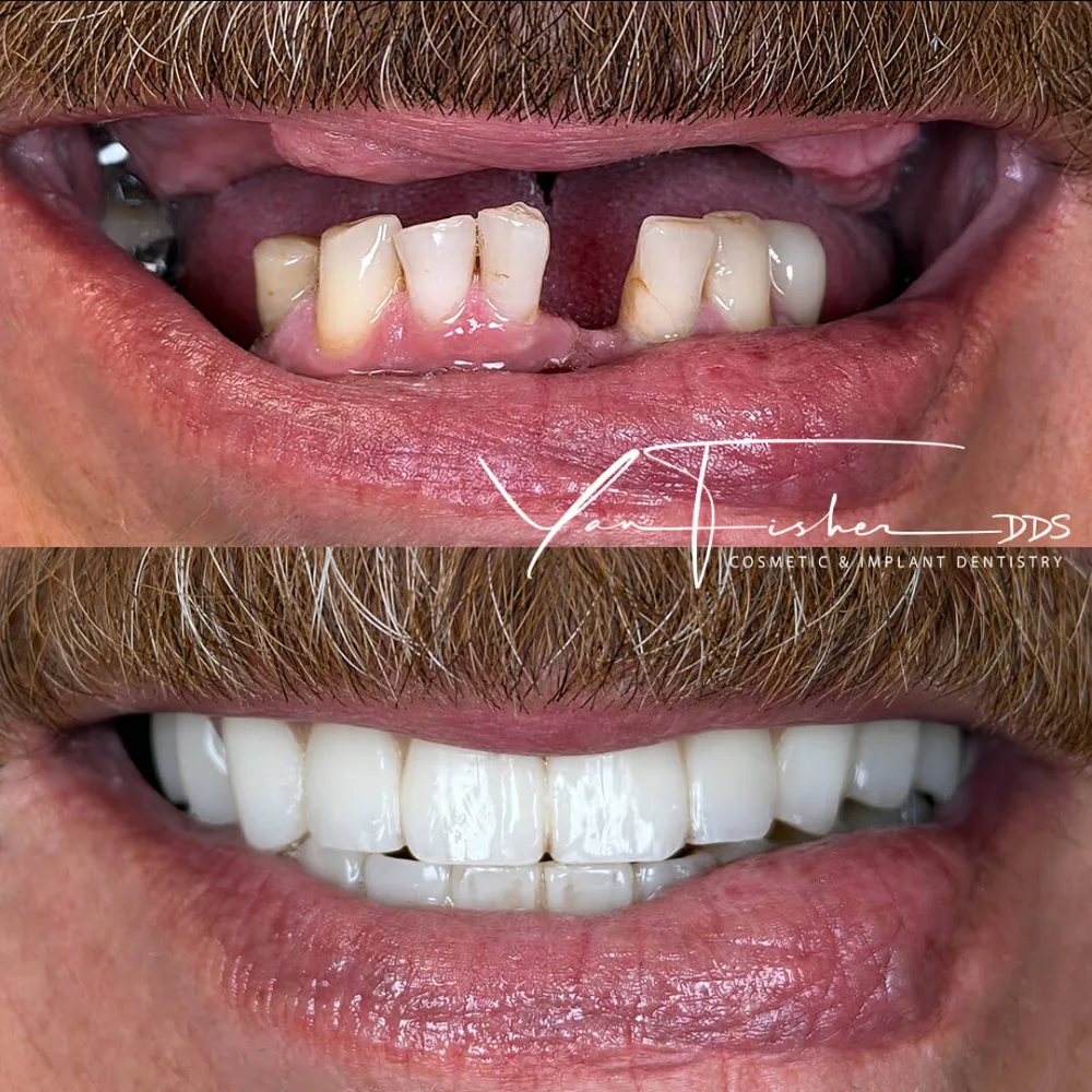 Robert Moline Before and After Smile