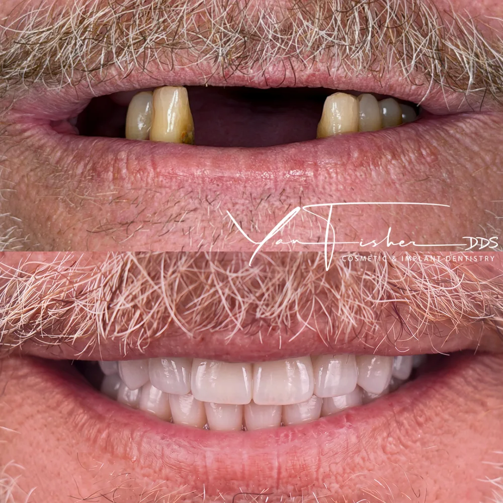Before and after smile transformation