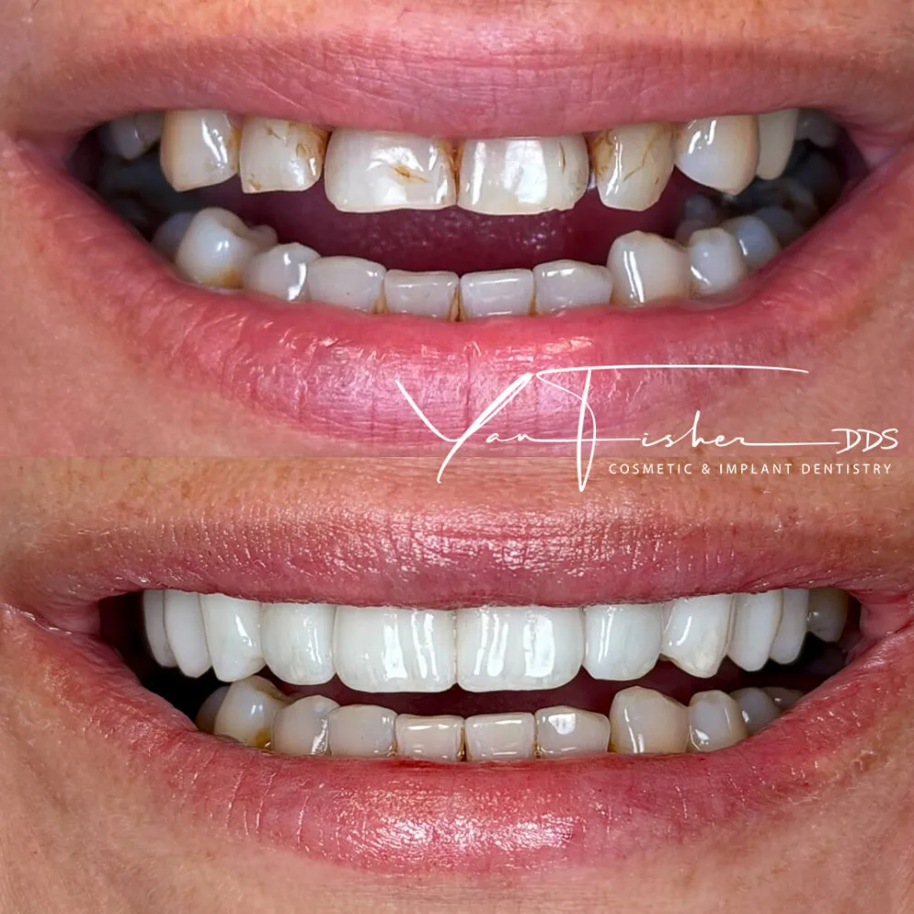 SHAHBAZIAN_KLOD BEFORE & AFTER Full Smile