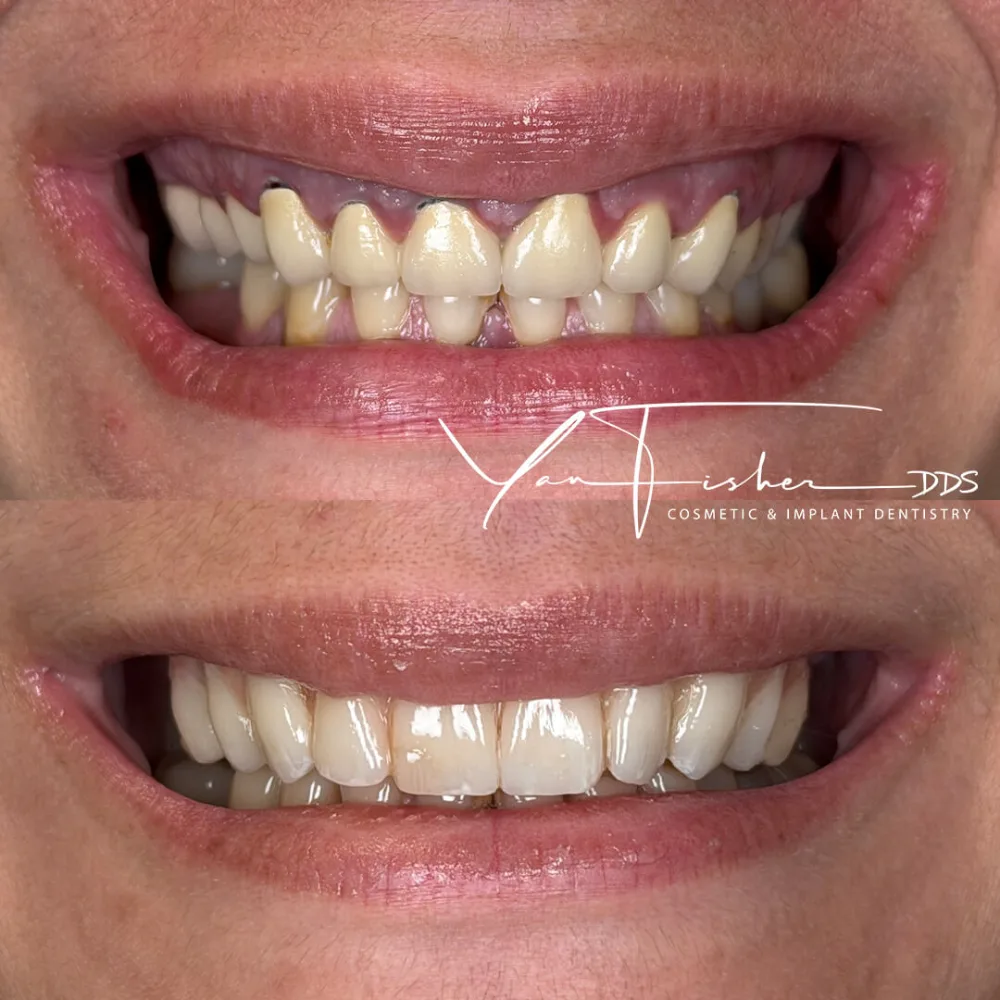 SHUSHAN BEFORE AND AFTER SMILE