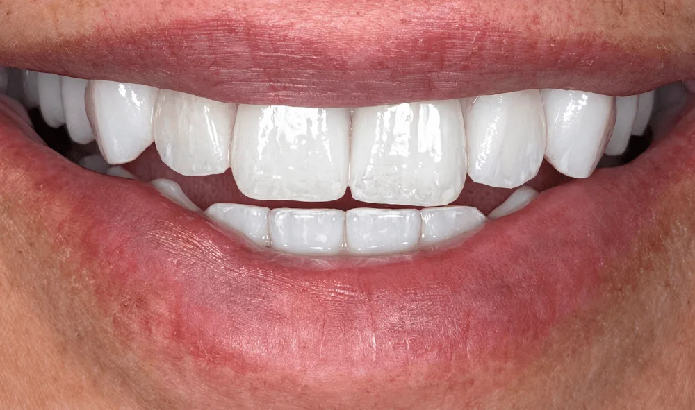 Smile after treatment